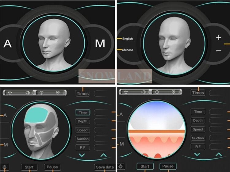 Máquina de depilação a laser de diodo semicondutor 808nm com sensor de contato com a pele, garantindo um tratamento rápido de depilação